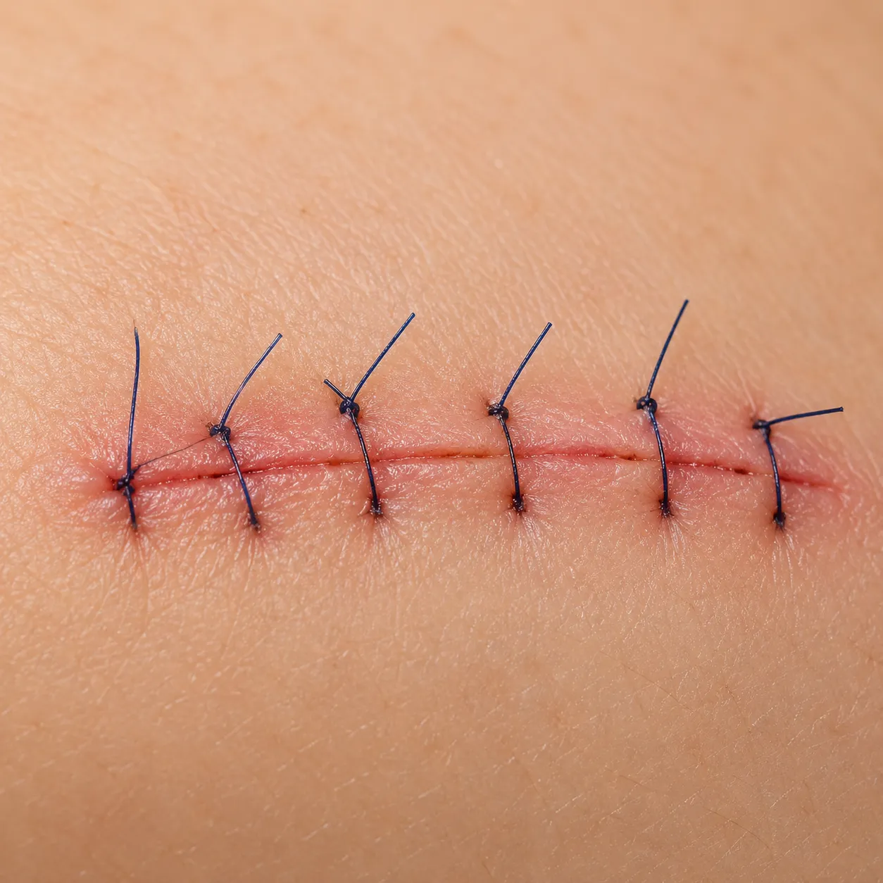 stitches
