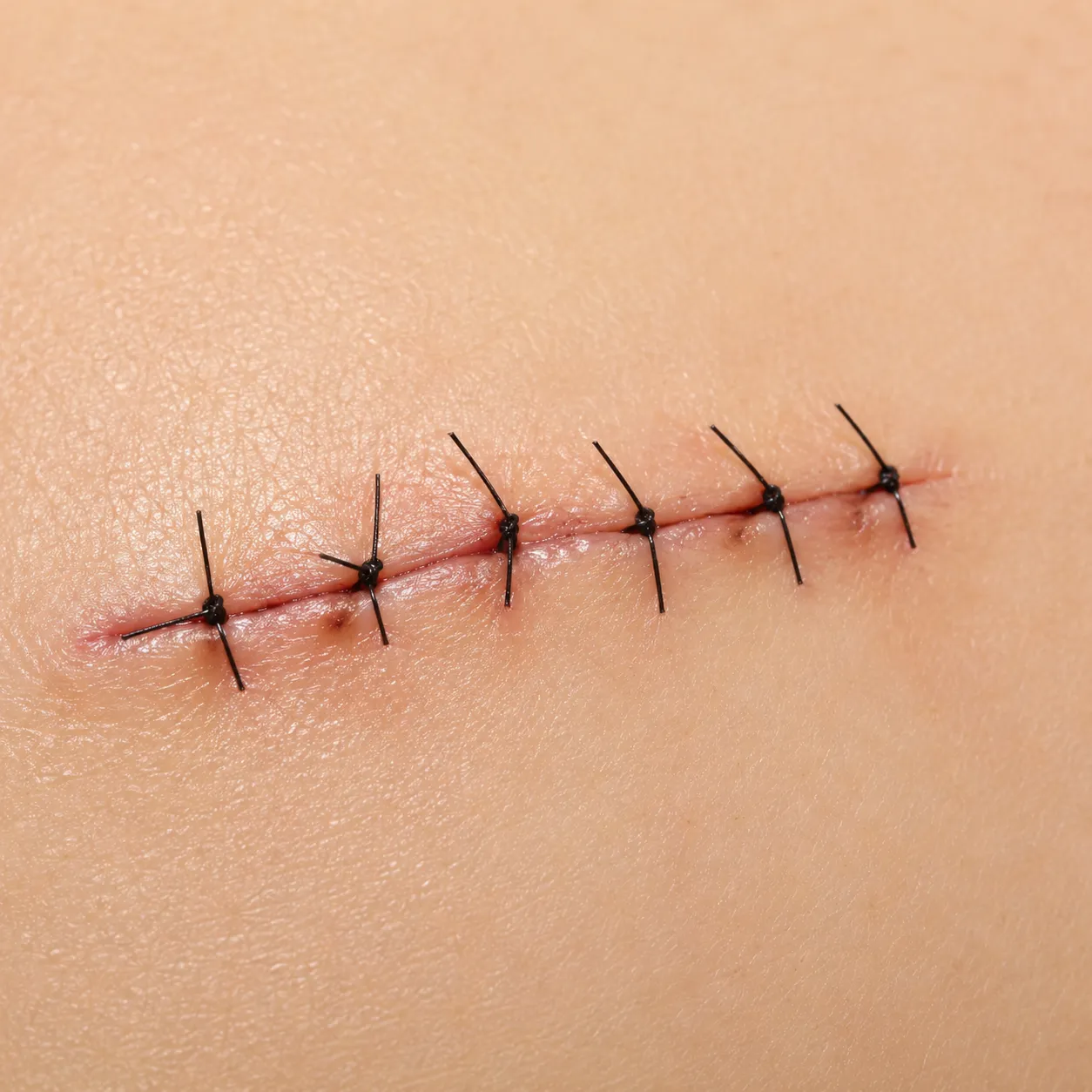 sutures