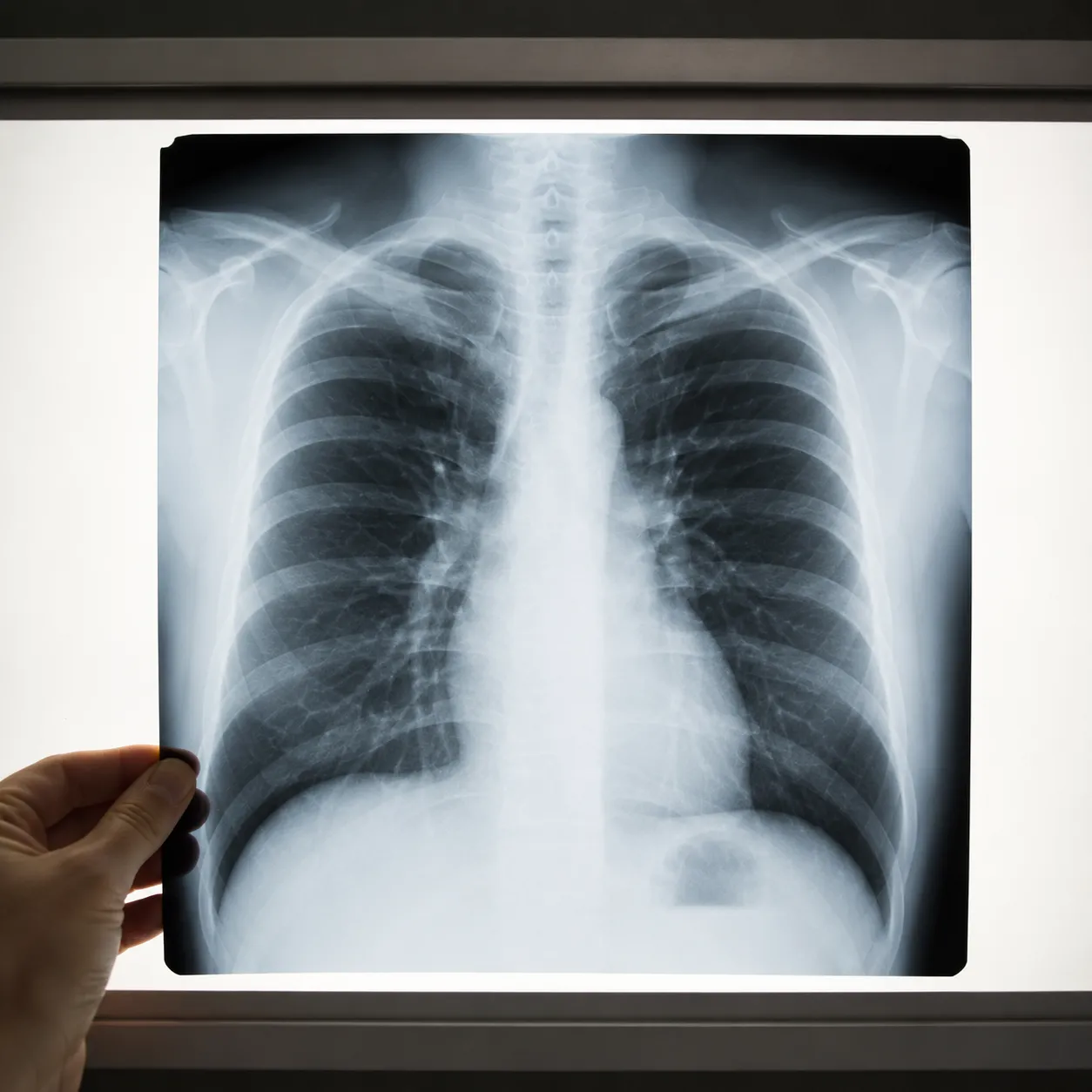 x-ray