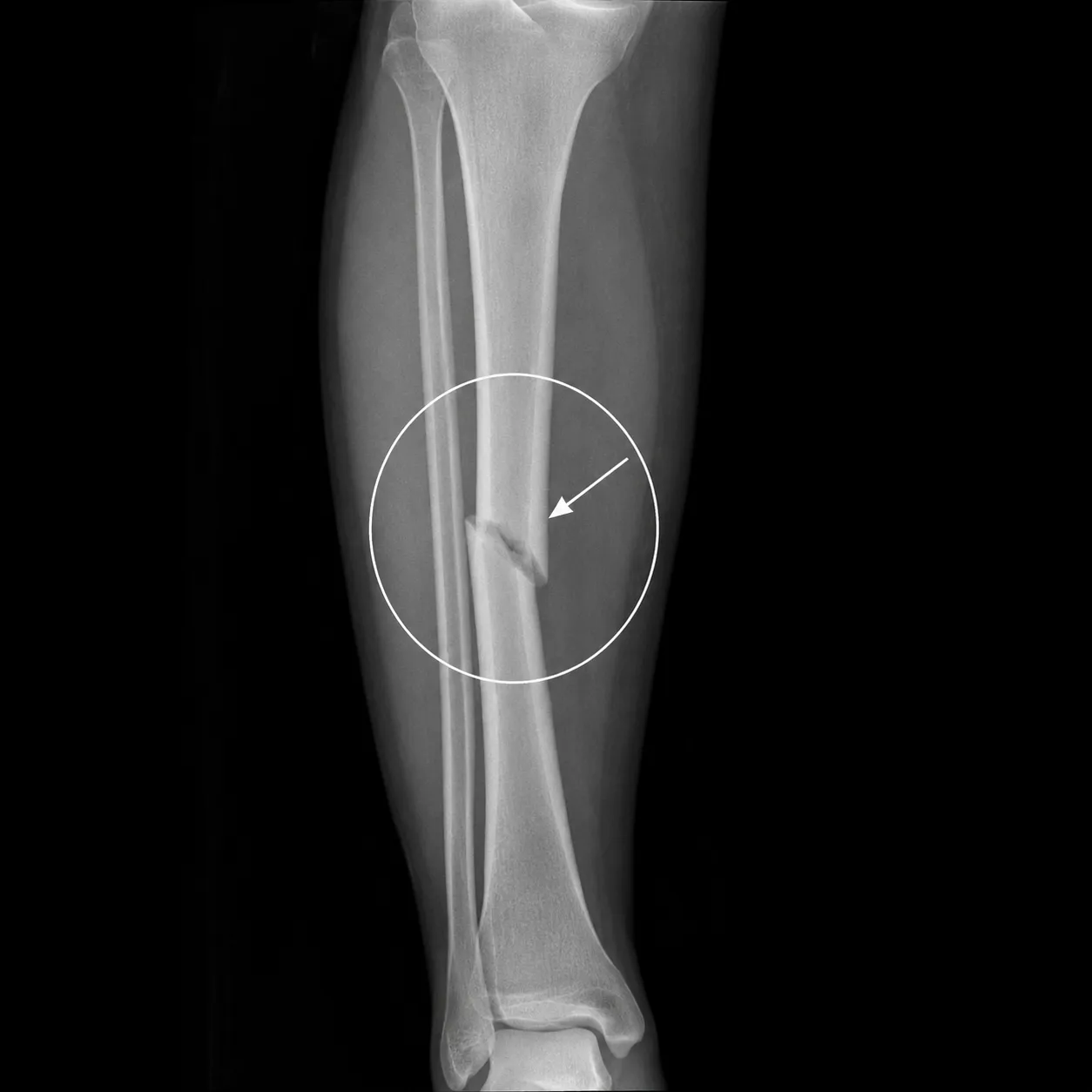 fracture