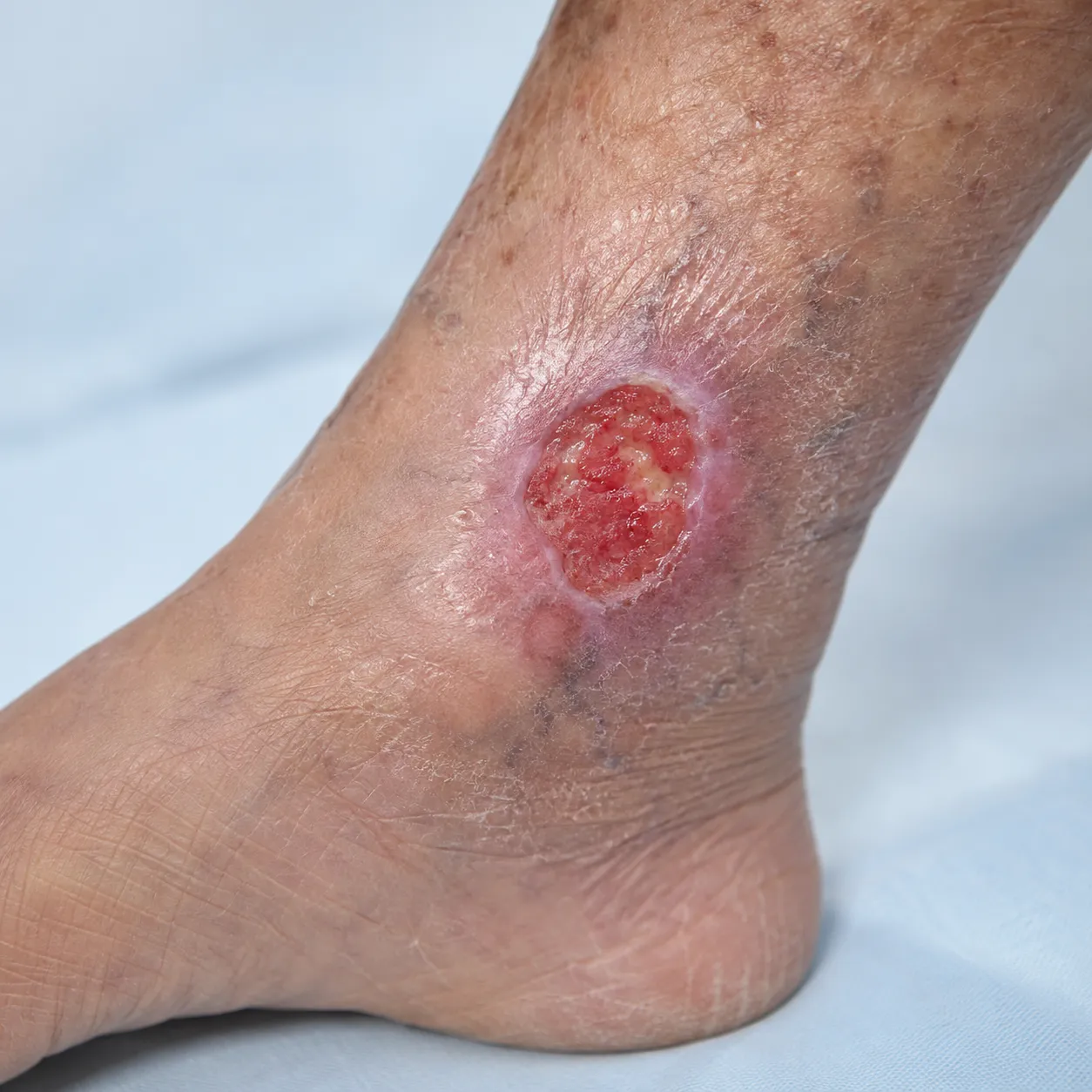 ulcer