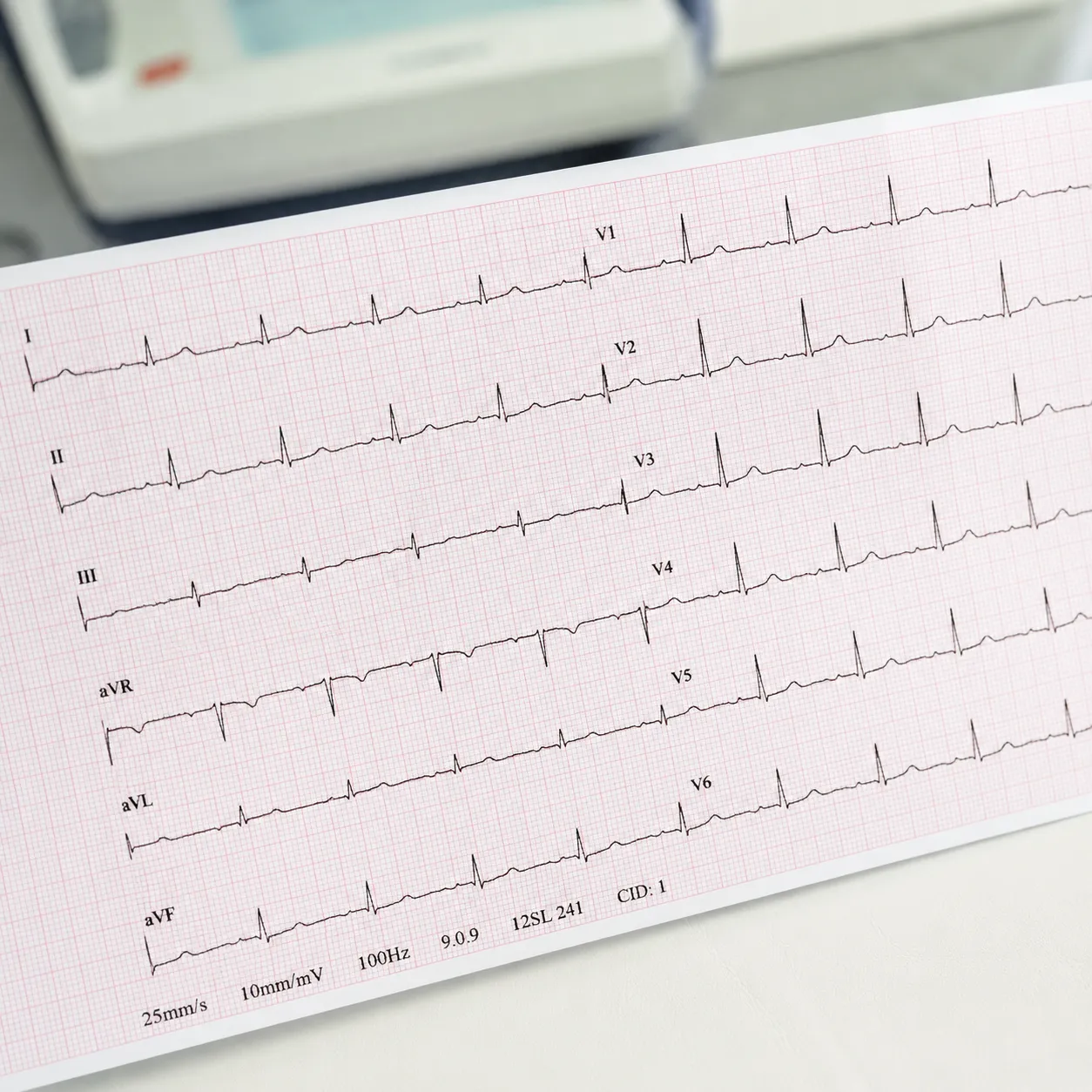 electrocardiogram