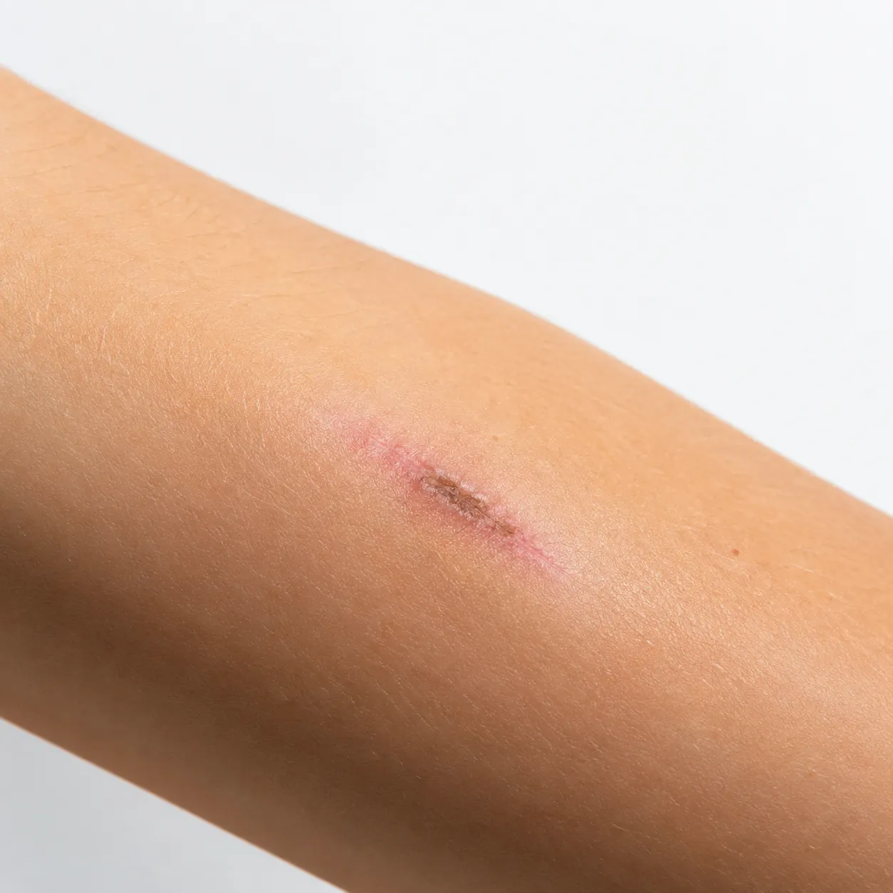 wound healing